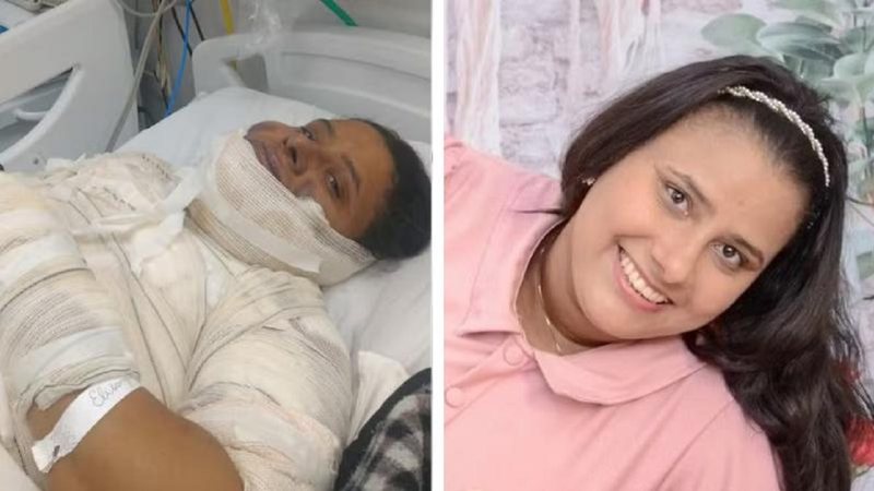 Morre A Mulher De Anos Que Sofreu Graves Queimaduras Fritando Ovo